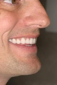 upperafter2 200x300 1