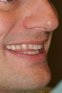 upperbefore2 200x300 1